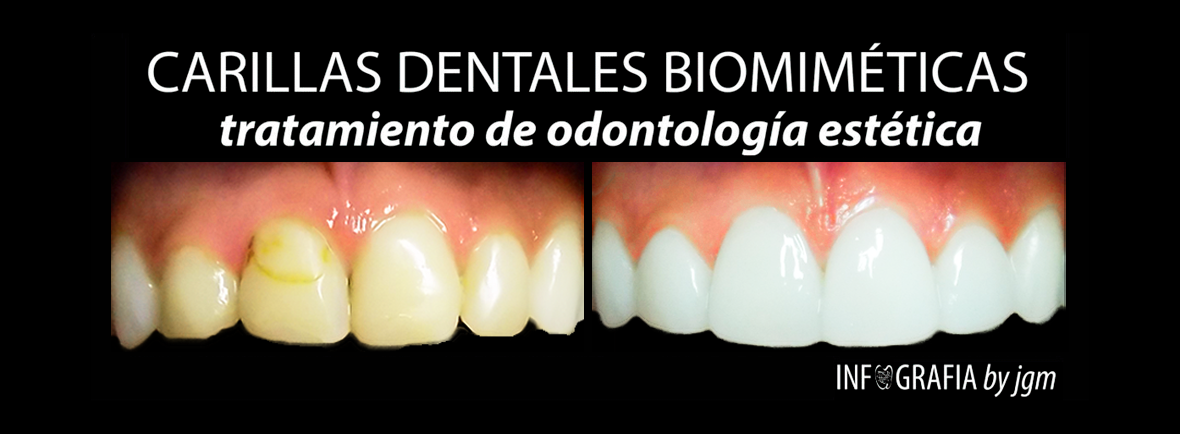 Carillas Biomimeticas OE-BN