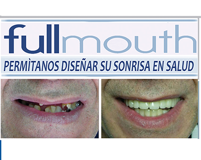 FullMouth 010
