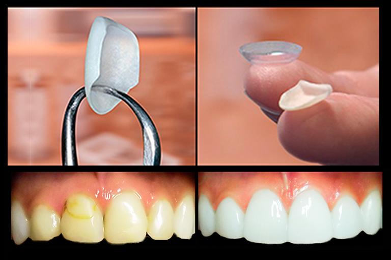 Carillas Biomiméticas Blog